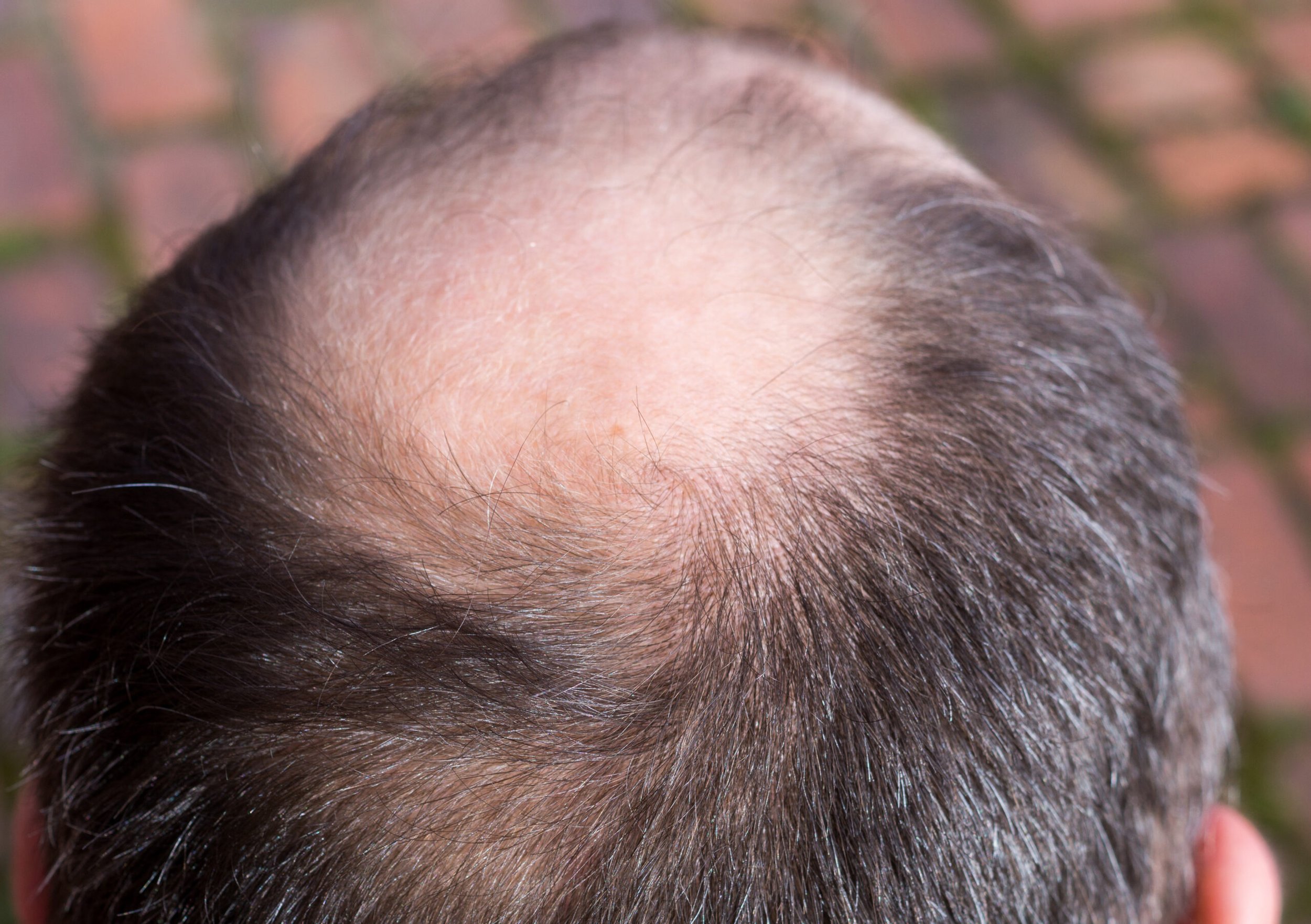 Foto von einer männlichen Kopfhaut mit deutlich erkennbaren Anzeichen von erblich bedingtem Haarausfall - auch bekannt als androgenetische Alopezie - insbesondere im Bereich des Oberkopfes.