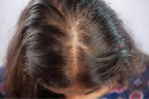Das Bild zeigte eine Frau mit lichter werdendem Scheitel (Female Pattern Hair Loss) im Rahmen von androgenetischem Haarausfall. Es ist ein Symbolbild für wie Bicalutamid Haarausfall stoppen kann.