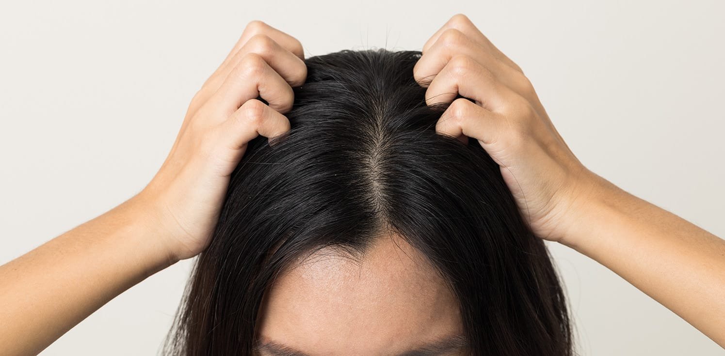 Frau, die sich mit den Händen auf die juckende Kopfhaut greift und kratzt