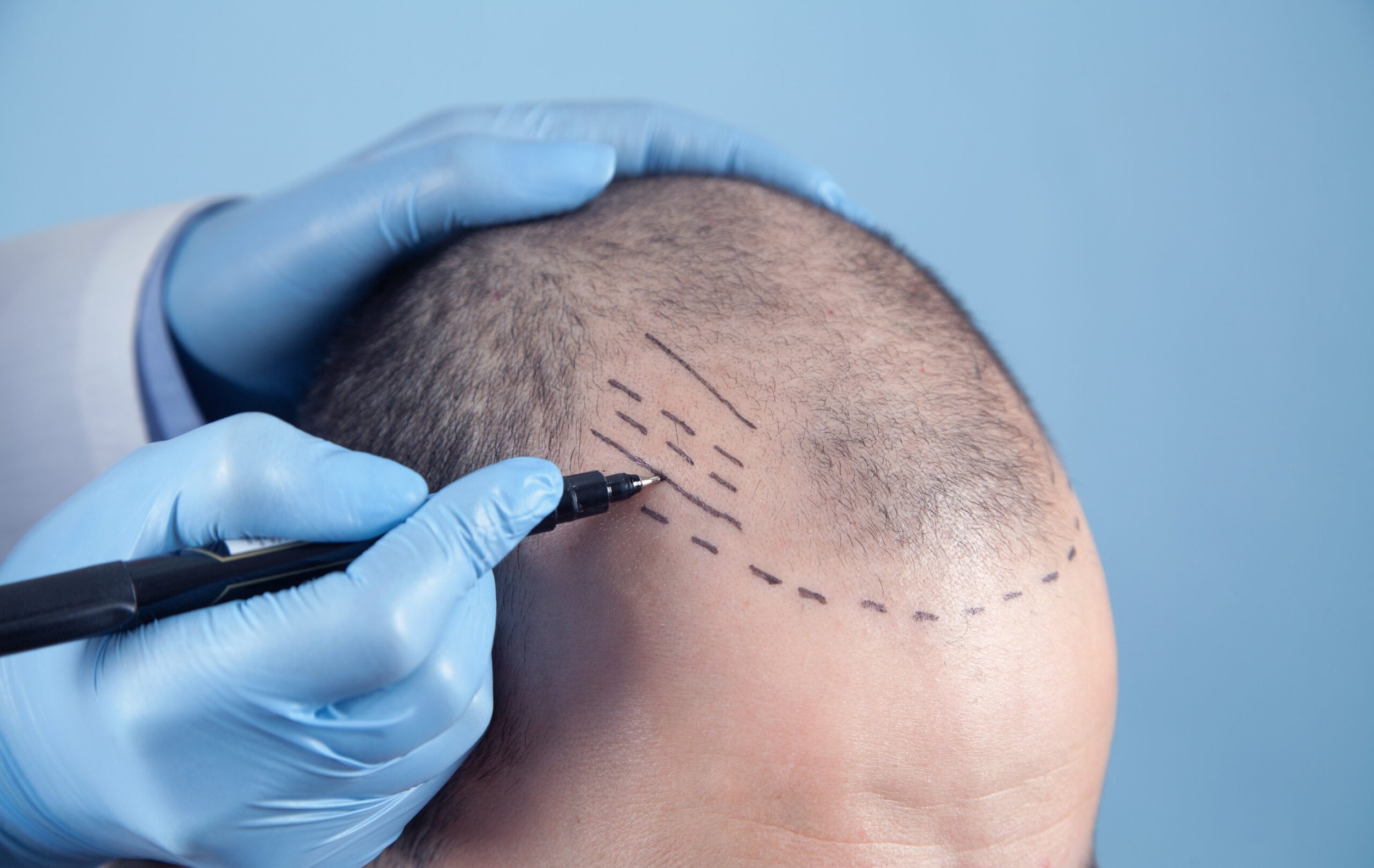 Ein Spezialist mit blauen Handschuhen zeichnet mit einem schwarzen Stift Markierungen auf die Kopfhaut eines Mannes mit Haarausfall, als Vorbereitung für eine Haartransplantation.