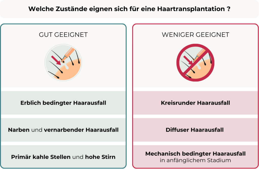 Die Grafik zeigt eine Gegenüberstellung von Zuständen, die sich für eine Haartransplantation eignen, und solchen, die weniger geeignet sind. Linke Spalte (Gut geeignet, Symbol: Haartransplantation, Implantation eines Grafts): Erblich bedingter Haarausfall Narben und vernarbender Haarausfall Primär kahle Stellen und hohe Stirn Rechte Spalte (Weniger geeignet, Symbol: durchgestrichene Haartransplantation): Kreisrunder Haarausfall Diffuser Haarausfall Mechanisch bedingter Haarausfall im anfänglichen Stadium Die Grafik hebt hervor, dass bestimmte Arten von Haarausfall besser für eine Haartransplantation geeignet sind als andere