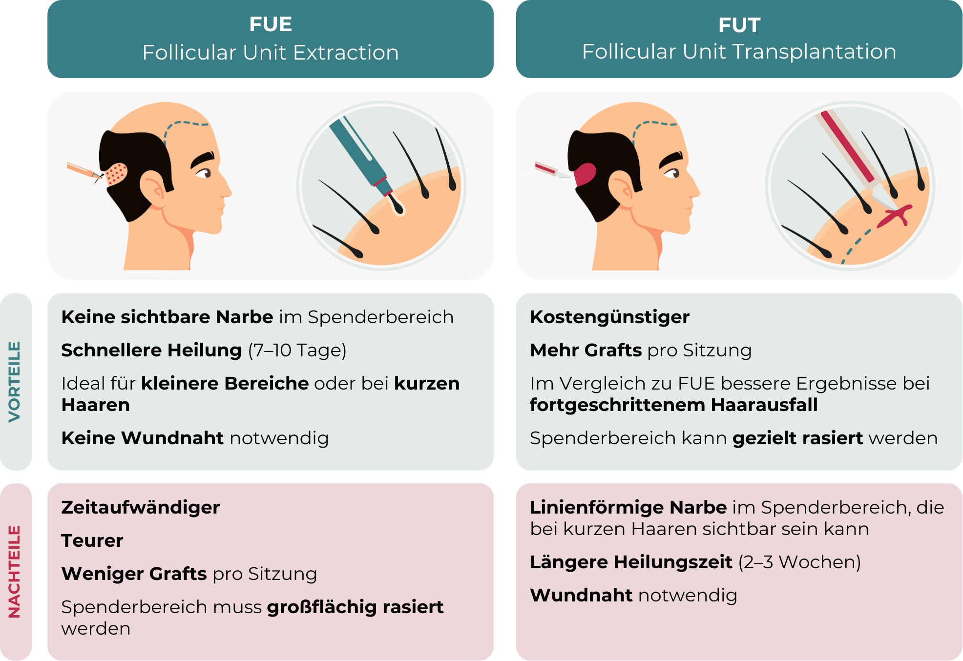Die Grafik beschreibt die Vor- und Nachteile der verschiedenen Entnahmemethoden bei einer Haartransplantation. Sie ist in zwei Spalten aufgeteilt – links FUE, rechts FUT. Jede Methode wird durch eine Illustration veranschaulicht: Bei FUE werden einzelne follikuläre Einheiten mit einem feinen Stanzwerkzeug entnommen, während bei FUT ein Hautstreifen aus dem Spenderbereich entnommen und die Grafts daraus extrahiert werden. Unter den Illustrationen sind die jeweiligen Vorteile und Nachteile in farblich abgesetzten Kästen dargestellt. Die FUE-Methode (Follicular Unit Extraction) hat den Vorteil, dass keine sichtbare Narbe im Spenderbereich entsteht und die Heilung schneller erfolgt (7–10 Tage). Sie eignet sich besonders für kleinere Bereiche oder für Personen mit kurzen Haaren. Zudem ist keine Wundnaht notwendig. Allerdings ist FUE zeitaufwendiger, teurer und es können pro Sitzung weniger Grafts entnommen werden. Außerdem muss der Spenderbereich großflächig rasiert werden. Die Grafik vergleicht die beiden Methoden der Haartransplantation: FUE (Follicular Unit Extraction) und FUT (Follicular Unit Transplantation). Sie ist in zwei Spalten aufgeteilt – links FUE, rechts FUT. Jede Methode wird durch eine Illustration veranschaulicht: Bei FUE werden einzelne follikuläre Einheiten mit einem feinen Stanzwerkzeug entnommen, während bei FUT ein Hautstreifen aus dem Spenderbereich entnommen und die Grafts daraus extrahiert werden. Unter den Illustrationen sind die jeweiligen Vorteile und Nachteile in farblich abgesetzten Kästen dargestellt. FUE-Vorteile (grüner Kasten): Keine sichtbare Narbe im Spenderbereich Schnellere Heilung (7–10 Tage) Ideal für kleinere Bereiche oder kurze Haare Keine Wundnaht notwendig FUE-Nachteile (rosafarbener Kasten): Zeitaufwendiger Teurer Weniger Grafts pro Sitzung Spenderbereich muss großflächig rasiert werden FUT-Vorteile (grüner Kasten): Kostengünstiger Mehr Grafts pro Sitzung Bessere Ergebnisse bei fortgeschrittenem Haarausfall Spenderbereich kann gezielt rasiert werden FUT-Nachteile (rosafarbener Kasten): Linienförmige Narbe im Spenderbereich, die bei kurzen Haaren sichtbar sein kann Längere Heilungszeit (2–3 Wochen) Wundnaht notwendig