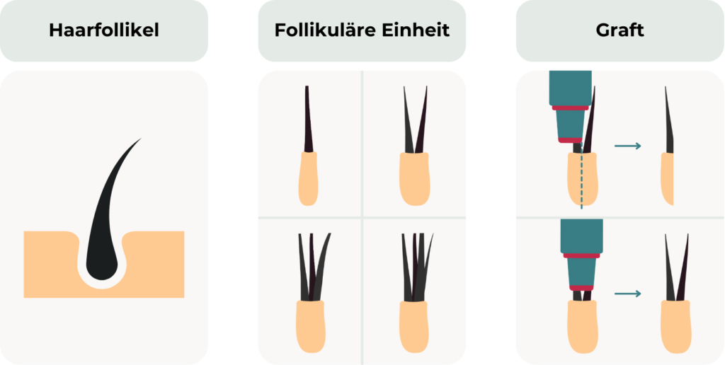 Die Grafik zeigt drei wesentliche Begriffe im Zusammenhang mit einer Haartransplantation: Haarfollikel: Eine einzelne Haarwurzel, eingebettet in die Kopfhaut. Jeder Follikel kann immer nur ein einzelnes Haar enthalten. Follikuläre Einheit: Eine natürliche Gruppierung von Haarfollikeln, die aus 1 bis 4 Haaren bestehen kann. Graft: Eine follikuläre Einheit, die für eine Haartransplantation entnommen und an eine neue Stelle verpflanzt wird. Die Abbildung zeigt die Extraktion eines Grafts mit einem Puncher, der die follikuläre Einheit zerteilt, sodass der Graft nur mehr aus einem Haarfollikel besteht. Darunter ist abgebildet, wie der Puncher die gesamte follikuläre Einheit herausstanzt. Beide Ergebnisse werden als Graft bezeichnet.