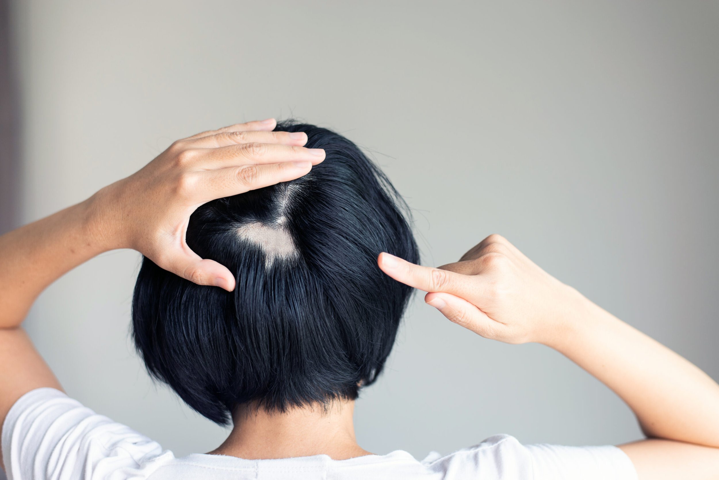 Rückansicht einer Frau mit schwarzem Haar, die auf eine kahle runde Stelle am Hinterkopf zeigt – ein typisches Merkmal von Alopecia areata, auch bekannt als kreisrunder Haarausfall.