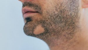 Kreisrunder Haarausfall im Bart eines Mannes, sichtbar durch kahle Stellen im Bartbereich.