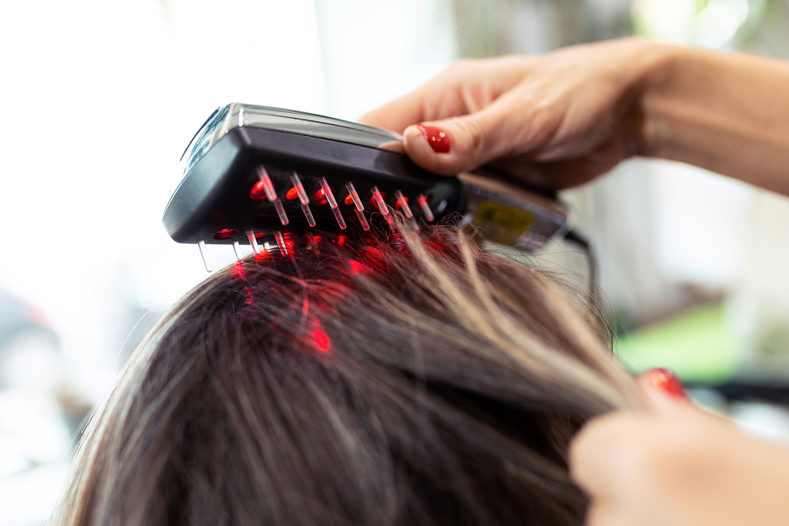 Ein Kamm mit Laserstrahlen wird auf den Kopf eines Menschen mit langen Haaren aufgesetzt, um Low-Level Lasertherapie bei Haarausfall durchzuführen.