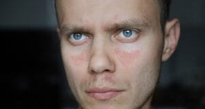 Nahaufnahme eines Mannes mit Lupus Haarausfall und rötlichen Hautausschlägen im Gesicht, charakteristisch für die Autoimmunerkrankung Lupus.