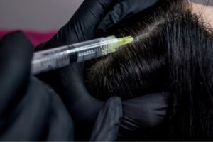 Das Bild zeigt wie mit einer feinen Kanüle die Kopfhaut injiziert wird. Es stellt die Behandlung Mesotherapie Haare (Mesohair) dar.