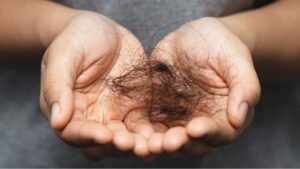 Hände halten ausgefallene Haare, gemeinsames Symptom bei sehr unterschiedlichen Ursachen von Haarausfall
