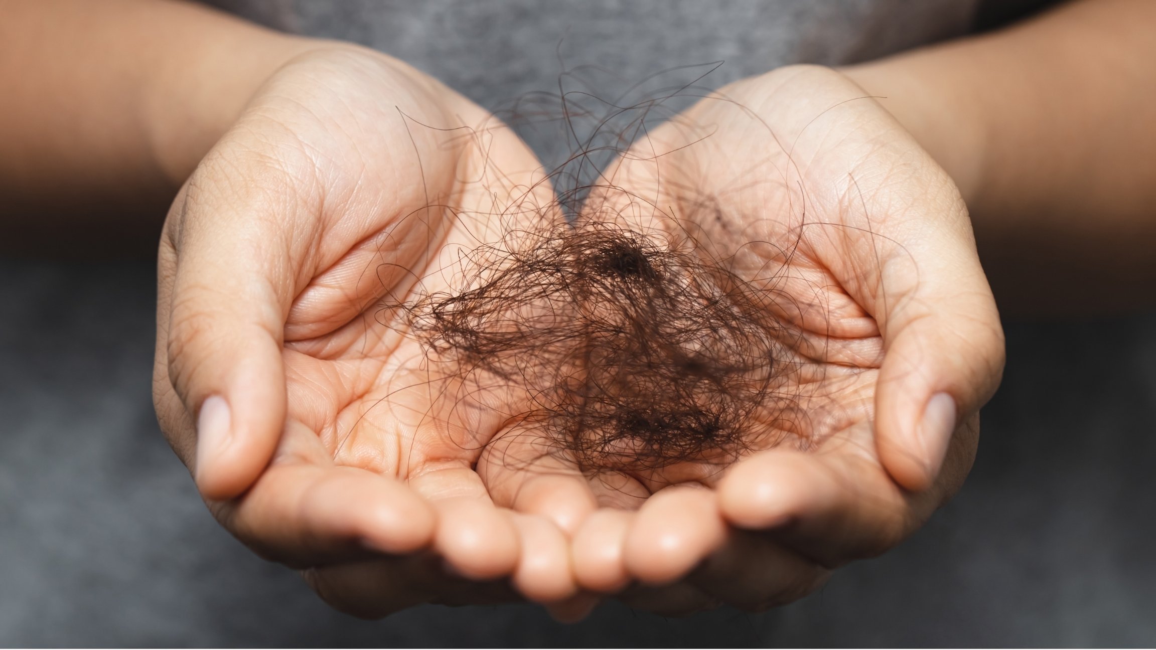 Hände halten ausgefallene Haare, gemeinsames Symptom bei sehr unterschiedlichen Ursachen von Haarausfall